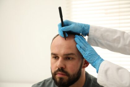 Greffe de cheveux en Belgique : pourquoi de plus en plus de patients choisissent l'expertise locale